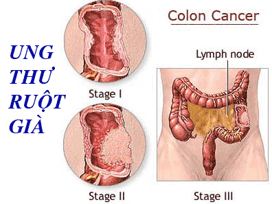 Colon cancer - Hình ảnh minh họa